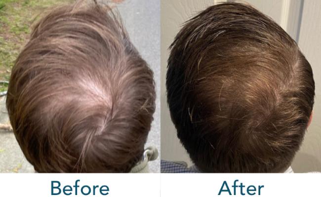 Before and after of Hair Therapy